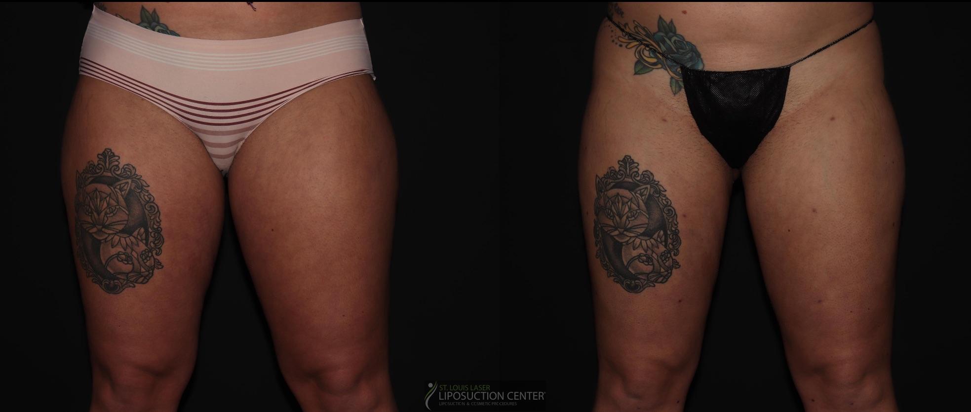 Before and After Image: Thighs - front