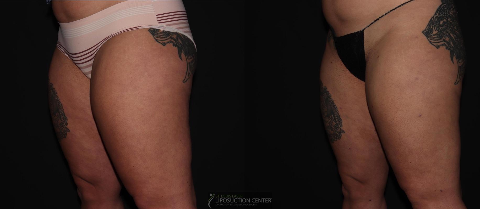 Before and After Image: Thighs - left-front-oblique
