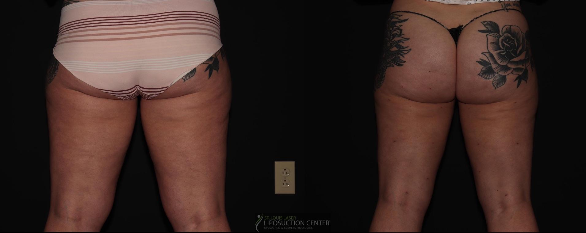 Before and After Image: Thighs - back