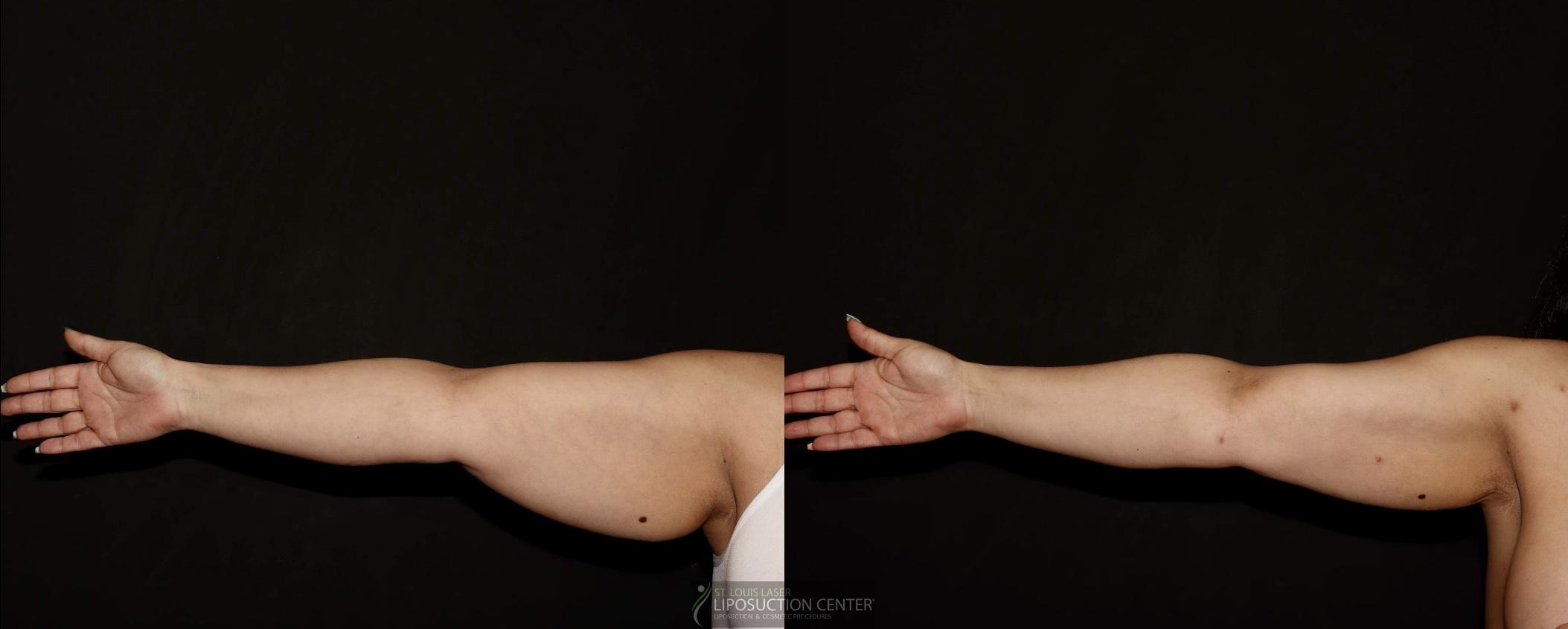 Before and After Image: Arms - front