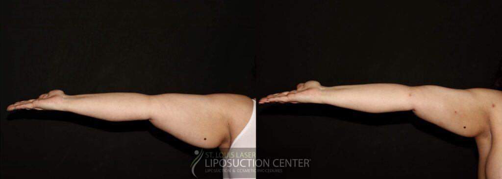 arms lipo c1.1 3 arms lipo c1.1 3