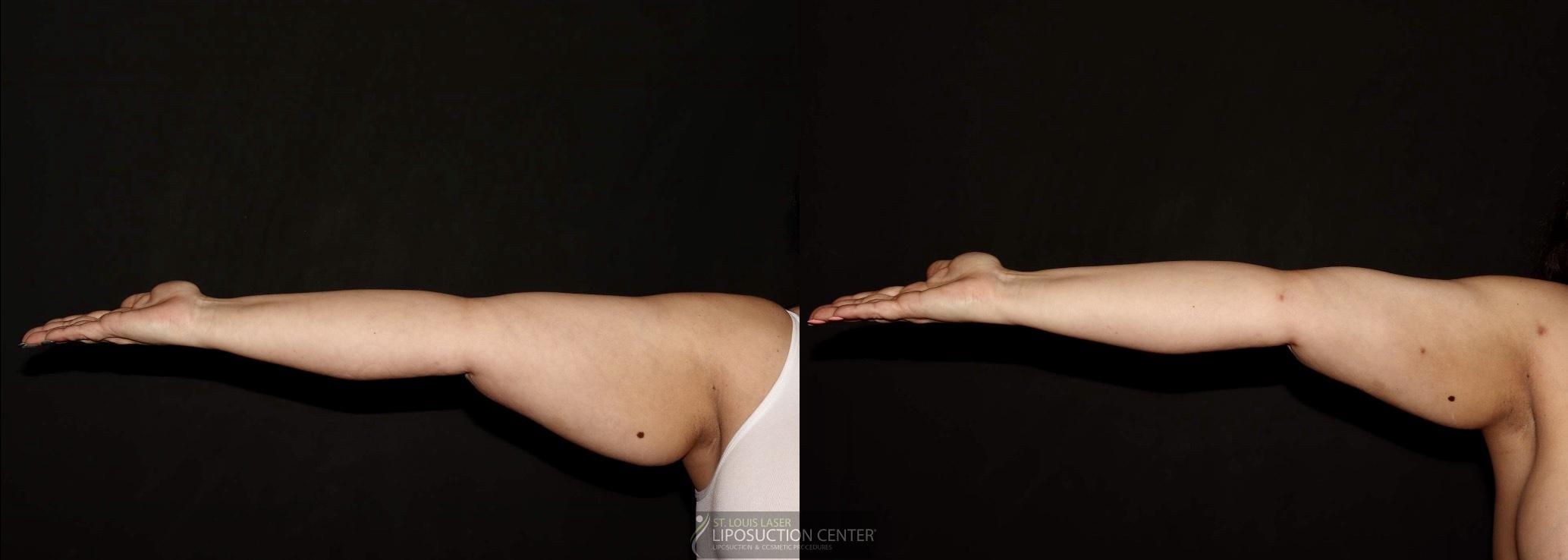 Before and After Image: Arms - front