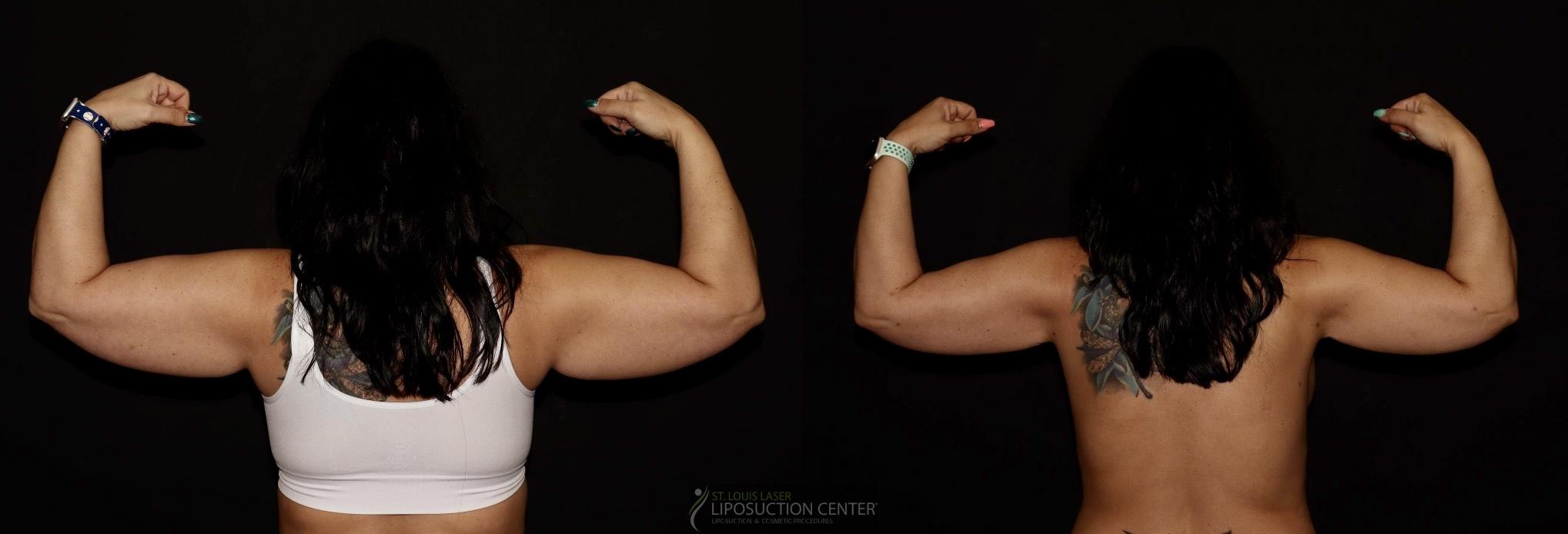 Before and After Image: Arms - back