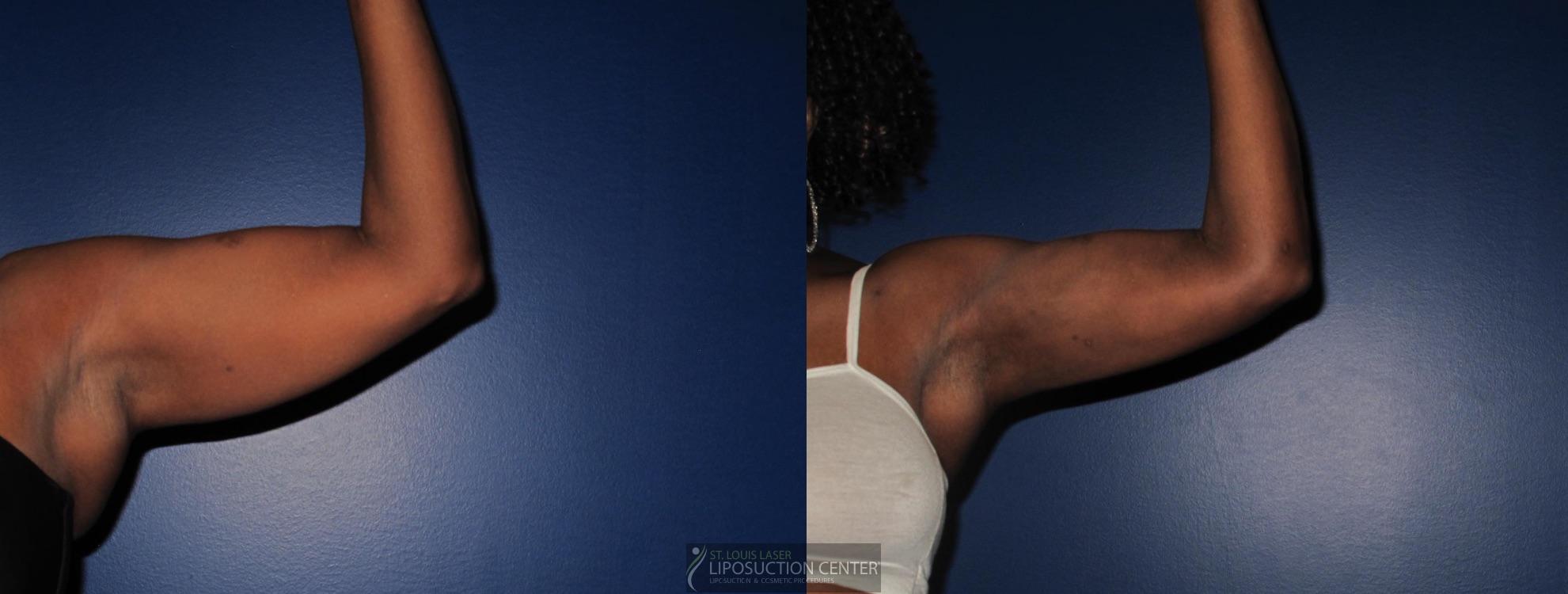 Before and After Image: Arms - front