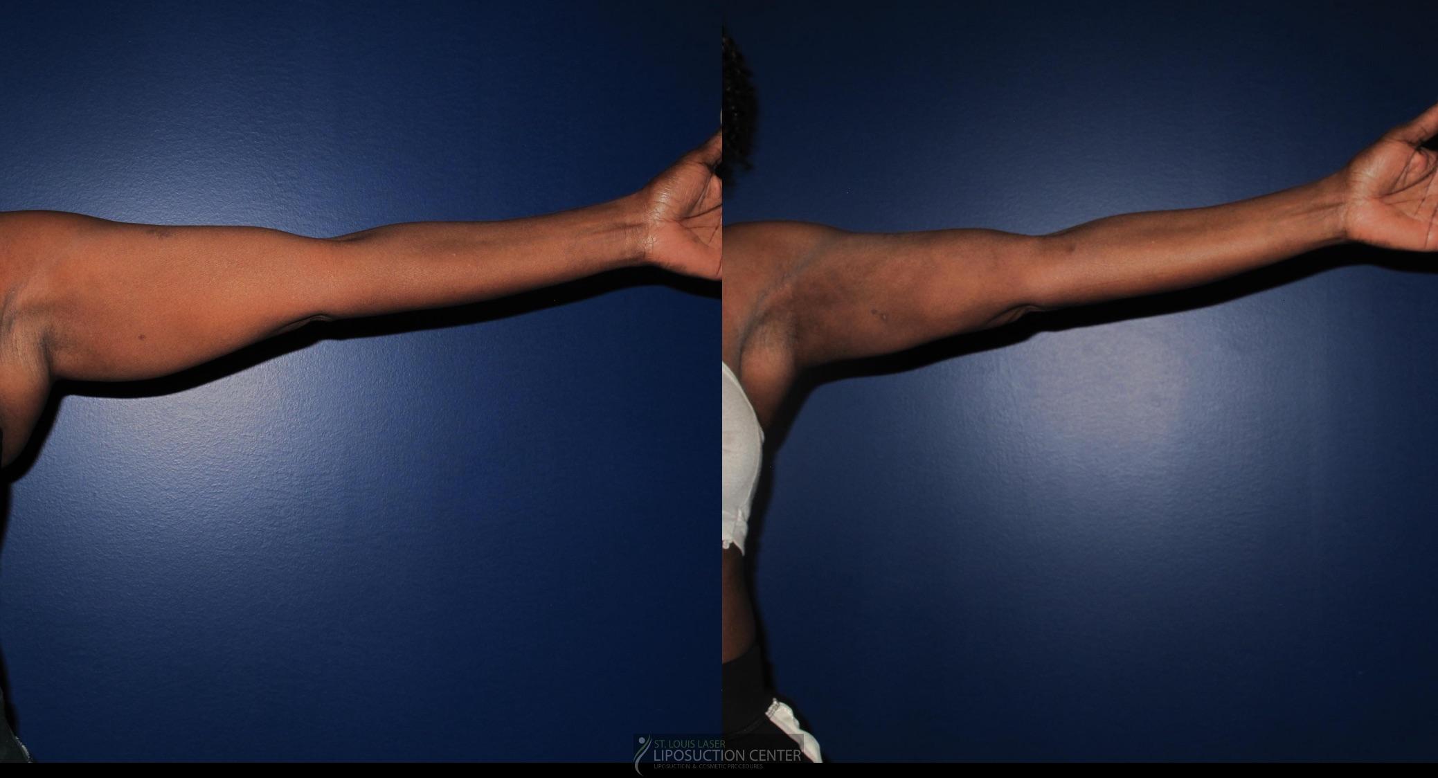 Before and After Image: Arms - front