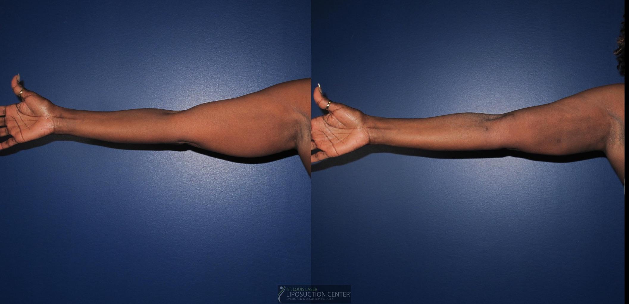 Before and After Image: Arms - front