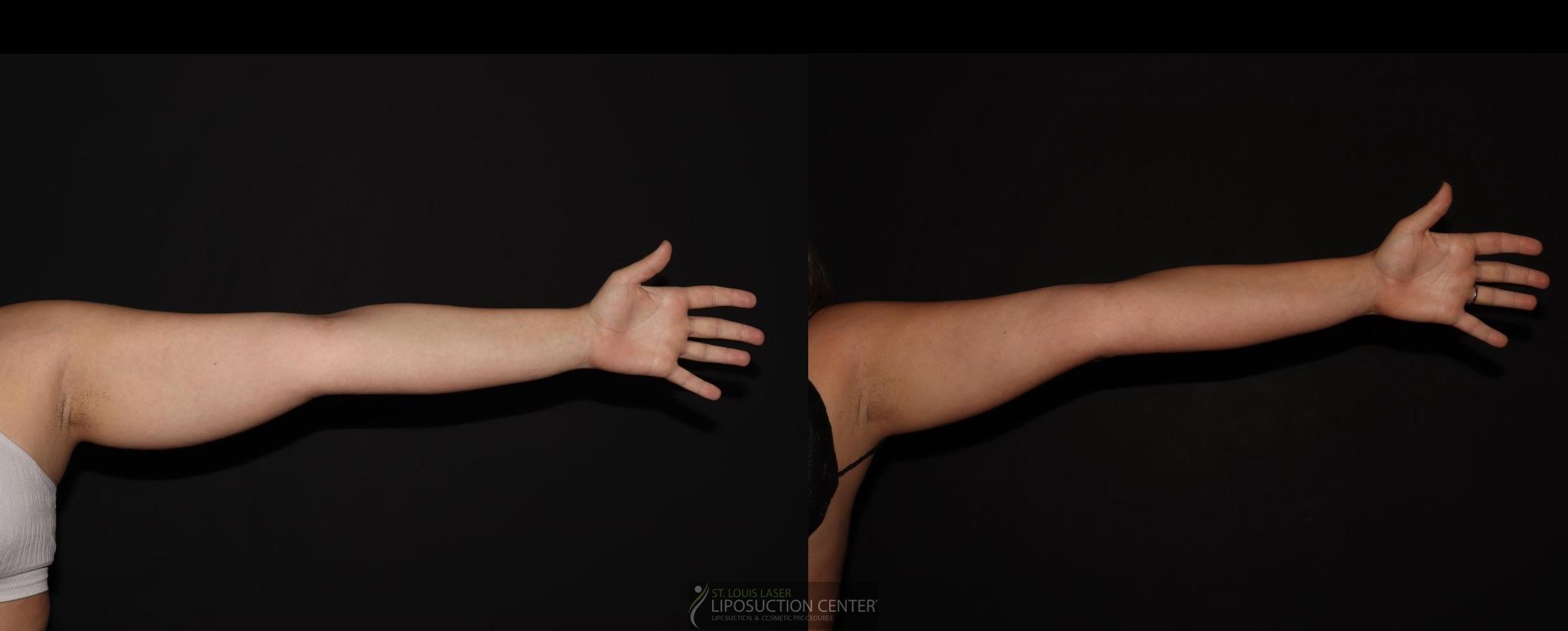 Before and After Image: Arms - front
