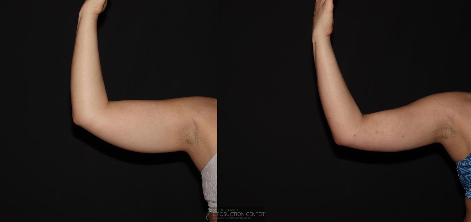 Before and After Image: Arms - front