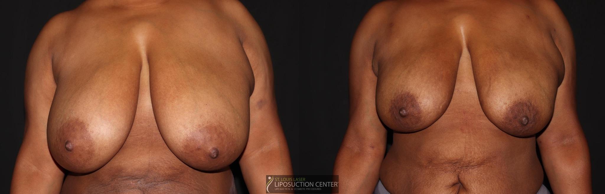 Before and After Image: Breast - front