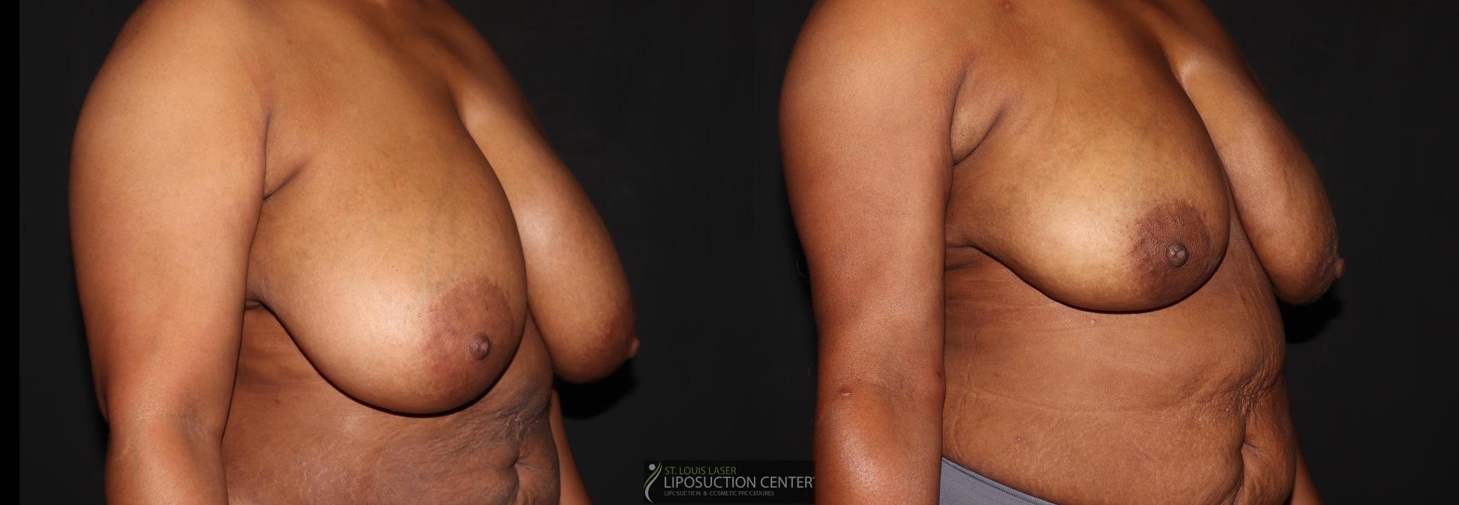 Before and After Image: Breast - right-front-oblique