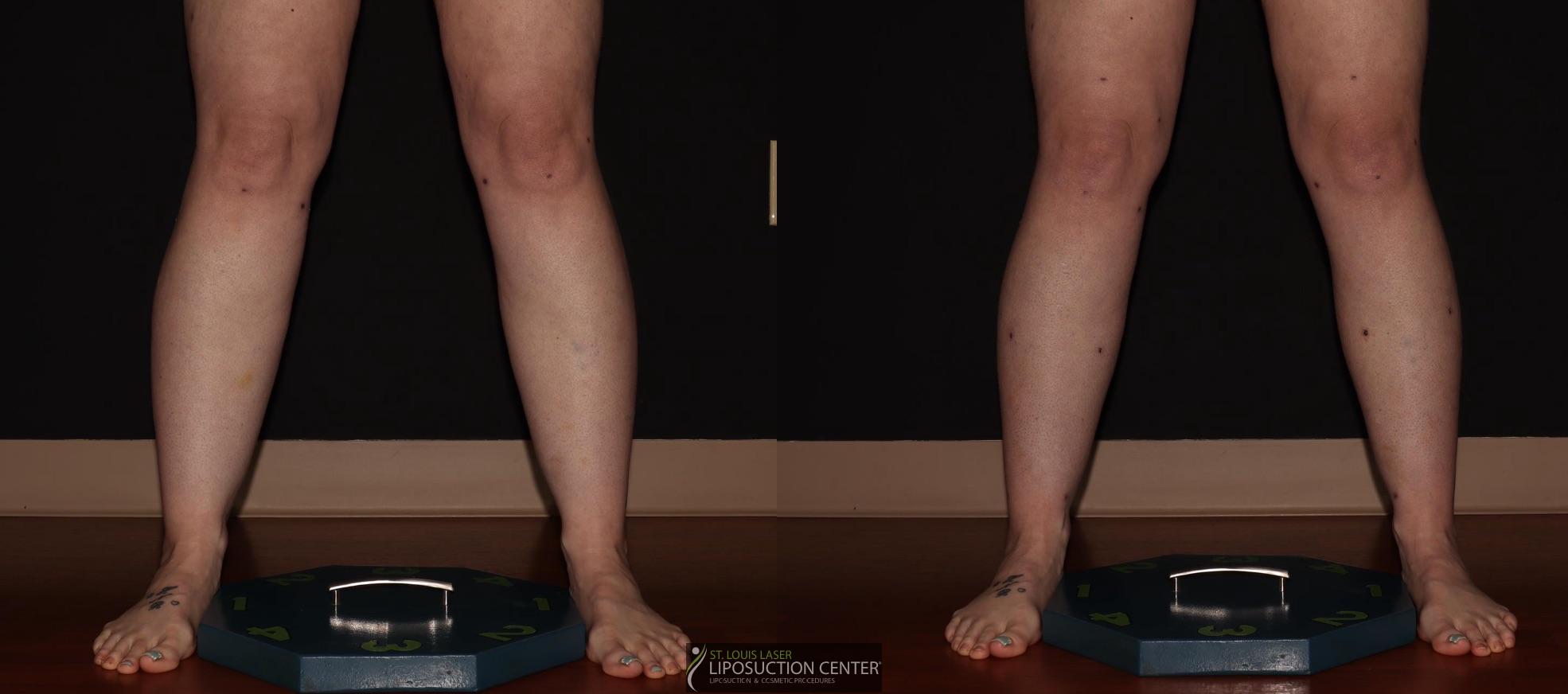 Before and After Image: Calves - front