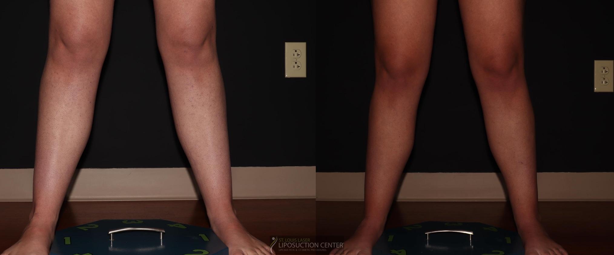 Before and After Image: Calves - front
