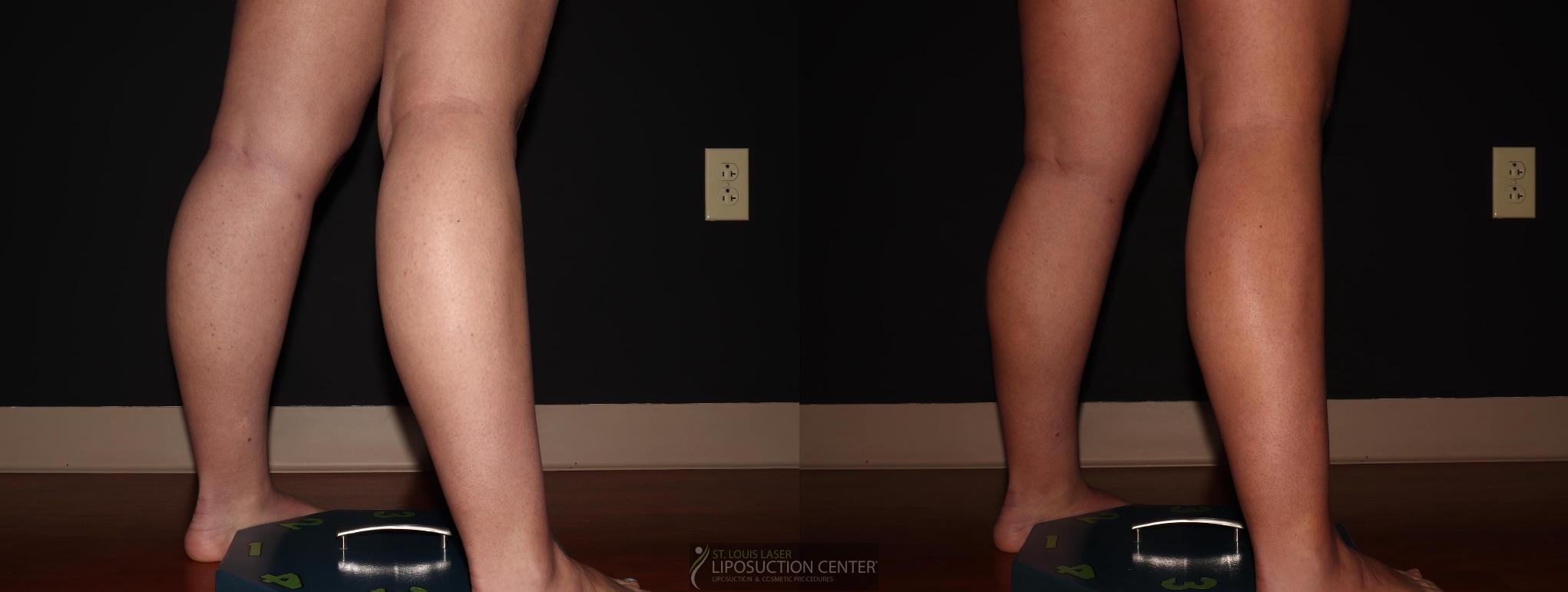 Before and After Image: Calves - right-back-oblique