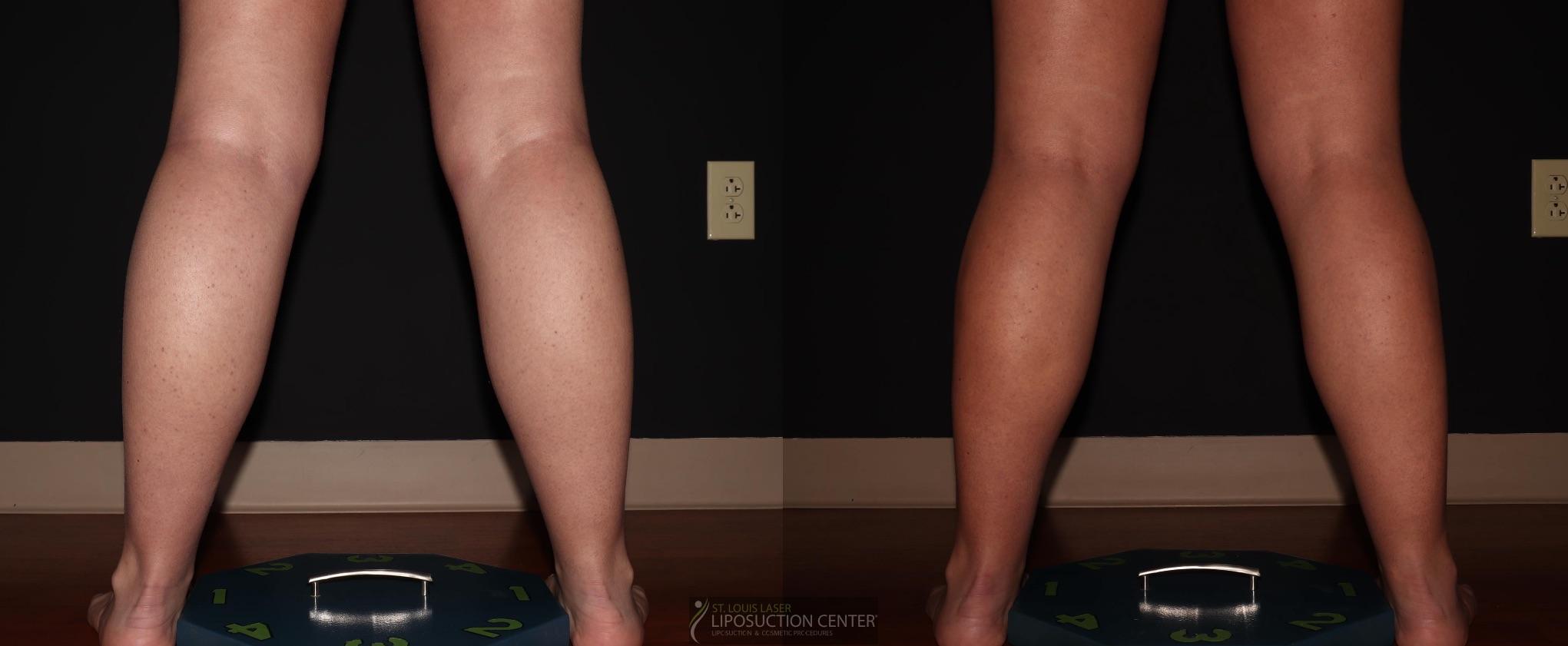 Before and After Image: Calves - back