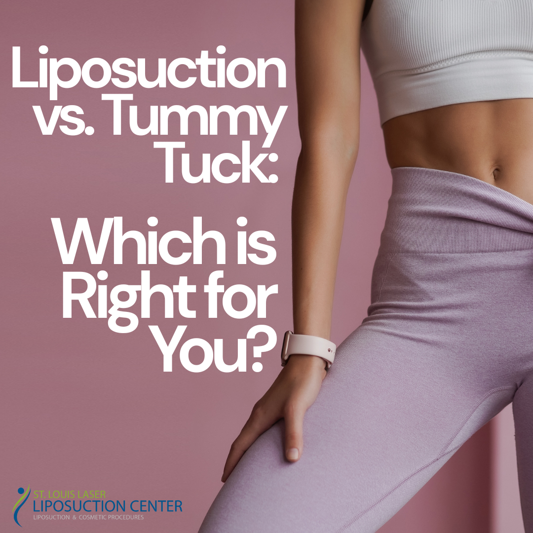 Liposuction vs. Tummy Tuck What’s Right for You
