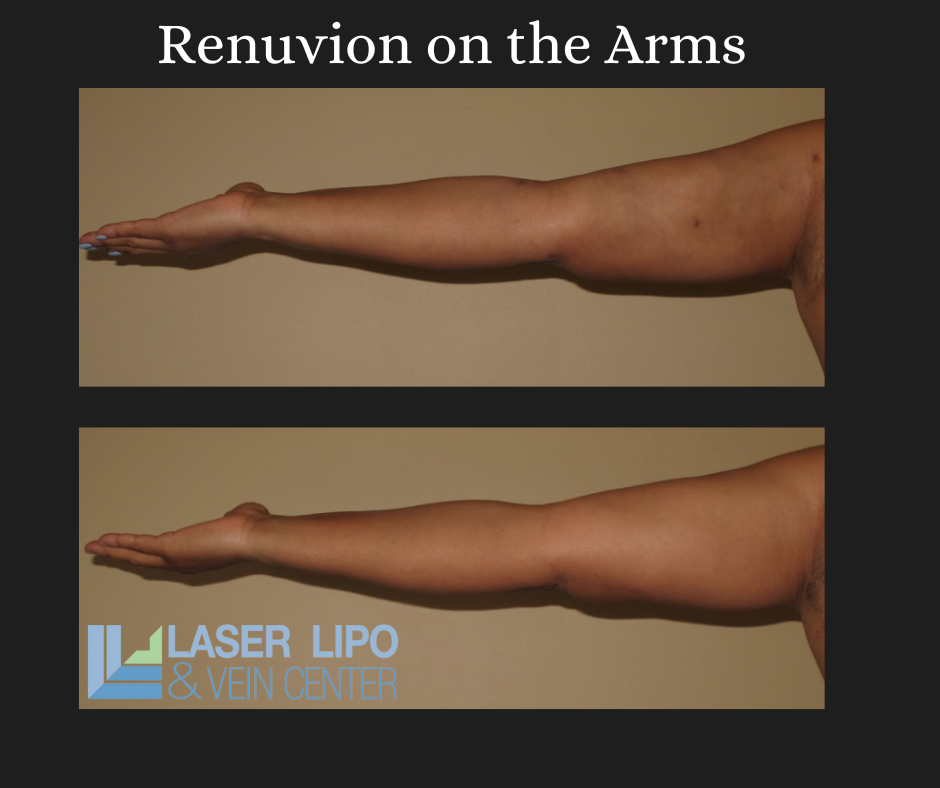 Renuvion & Lipo Before and After (1)