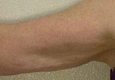 skin tightening arms after