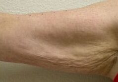 skin tightening arms before