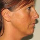 skin tightening face after 1