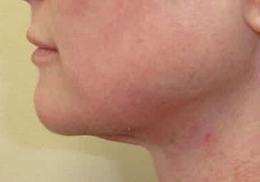 skin tightening face after