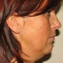 skin tightening face before 1