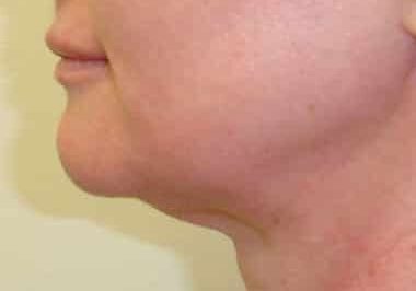 skin tightening face before