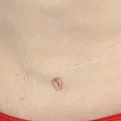 skin tightening stomach after