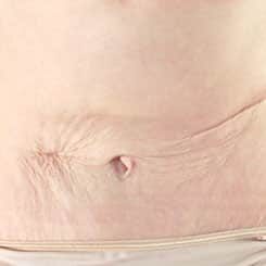 skin tightening stomach before